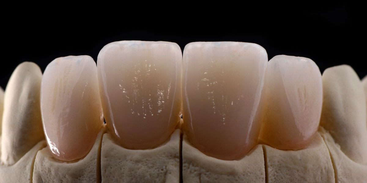 Qué son las carillas dentales y sus ventajas - Clínica Dental Barcelona